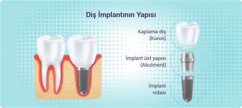İmplant Çeşitleri İmplant Çeşitleri