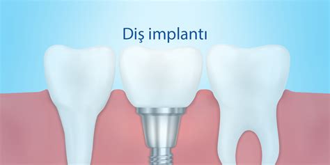 İmplant Çeşitleri İmplant Çeşitleri