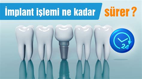 İmplant Süresi İmplant Süresi