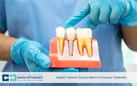 İmplant Yapımı ve Teknolojiler İmplant Yapımı ve Teknolojiler
