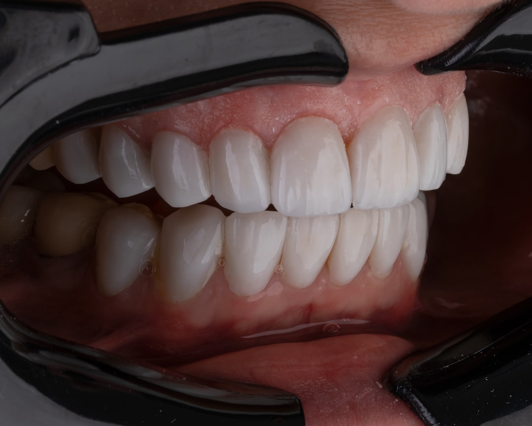 All on 4 dental implants All on 4 dental implants